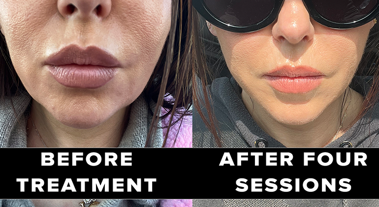 CurrentBody RF device before and after on jowls