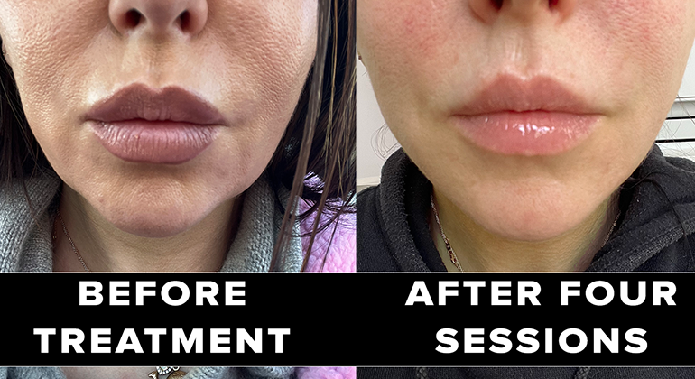 CurrentBody Before and after on pre-jowls and saggy neck